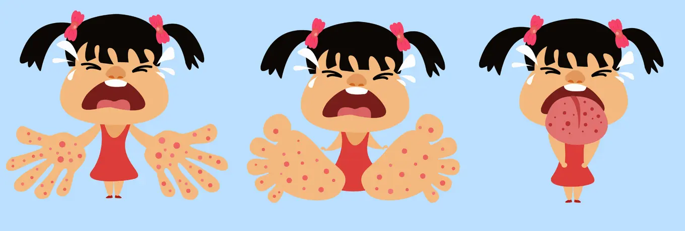 Girl with Hand, Foot, and Mouth Disease 